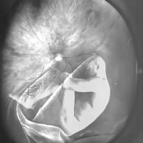 RETINA